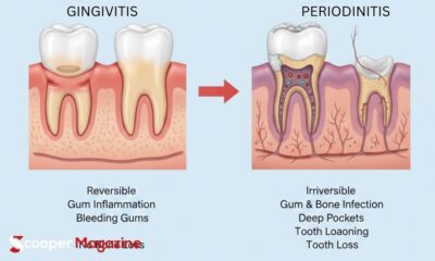 gingivitis vs periodontitis