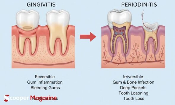 gingivitis vs periodontitis